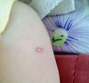 淄博割雙眼皮哪家醫(yī)院好？選擇正規(guī)醫(yī)院，安全放心！