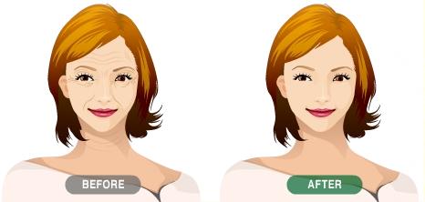 實現(xiàn)雙眼皮需要經(jīng)歷哪些步驟？注意事項又有哪些？