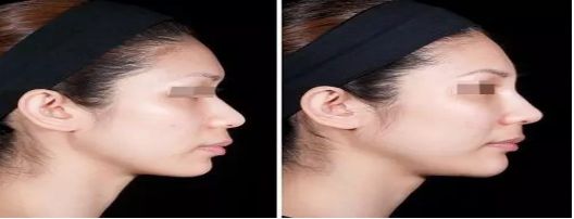 長(zhǎng)沙小腿溶脂吸脂醫(yī)院口碑榜單：權(quán)威推薦