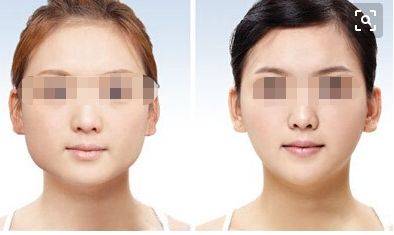 深圳懸吊提升術(shù) 口碑見證 締造年輕塑顏傳奇