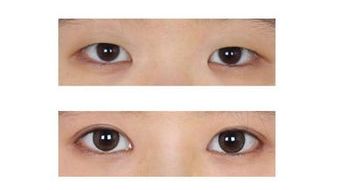 合肥假體隆鼻優(yōu)質(zhì)醫(yī)院大推薦，找專業(yè)醫(yī)生解答！