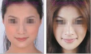 成都哪家整形醫(yī)院雙下巴去除效果好？排行前10強(qiáng)大揭秘