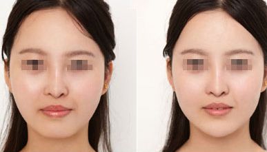 深圳干紋祛除醫(yī)院推薦：十大好口碑醫(yī)院大公開