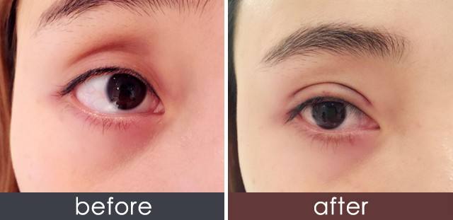 2023年上海很受好評的木偶紋射頻去除醫(yī)療美容醫(yī)院排名揭曉！