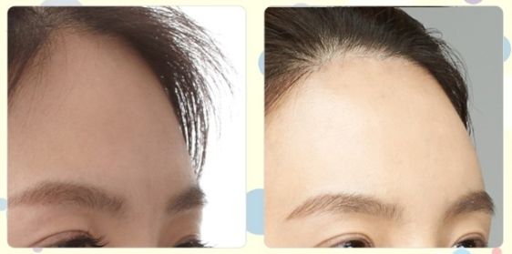 廣州痘痘治療哪家醫(yī)院效果最佳，口碑最好