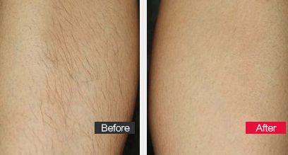 頭寬是否真的可以通過整容手術進行改變？—揭秘現(xiàn)代整容技術下的額頭寬改造方法