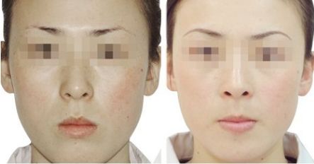 鄭州人氣口碑十佳眼部玻尿酸注射醫(yī)院名單