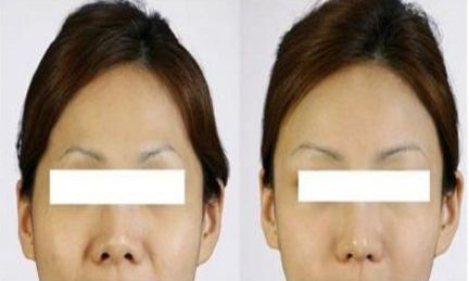 西安十佳小切口微創(chuàng)雙眼皮整形醫(yī)院榜單，專家評(píng)選