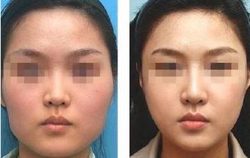 廊坊眼角去黃褐斑醫(yī)療整形專家推薦，10家正規(guī)醫(yī)院排名揭秘