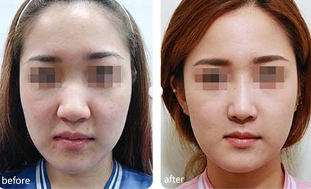 長(zhǎng)沙隆鼻翼專家醫(yī)院TOP10精選