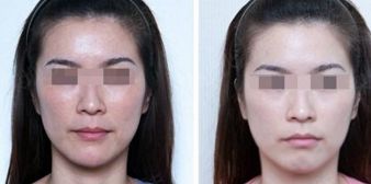 寧波權(quán)威整形醫(yī)院排名揭曉：實力雄厚，打造卓越美學(xué)