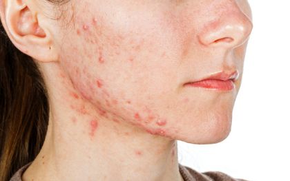 南京專業(yè)切眉手術(shù)：1800元起，費(fèi)用5-8千元可期！