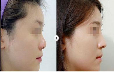 包頭鼻孔縮小醫(yī)院口碑榜單：10家值得信賴的整形機構