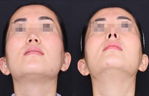 預(yù)測(cè)：西安微晶磨削去頸紋醫(yī)院排名榜單大揭秘！