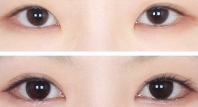 北京哪家醫(yī)院割雙眼皮技術好？