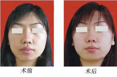 寧波水光針整形美容醫(yī)院哪家好？前十榜單全公開！