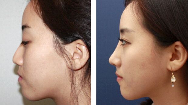 常州治療魚尾紋醫(yī)院推薦，讓你恢復(fù)青春美麗的秘密