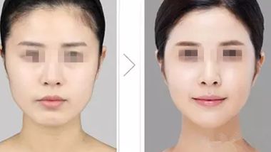 廈門哪家醫(yī)院做自體脂肪豐臉部整形效果好？Top10強醫(yī)院揭秘