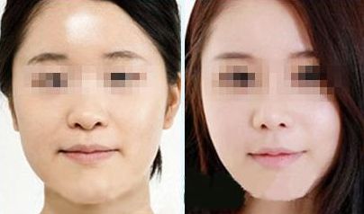 揚(yáng)州小切口祛眼底紋醫(yī)院推薦指南