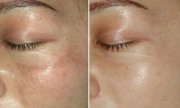 【2023蘭州哪家醫(yī)院鼻子整形效果好？專家推薦+真實患者案例】