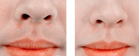 長春哪家雙眼皮做的好？專業(yè)告訴你如何選擇最適合你的雙眼皮手術(shù)醫(yī)院