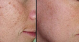 石家莊去痘坑的醫(yī)院排名與口碑調(diào)查，哪家醫(yī)院好？