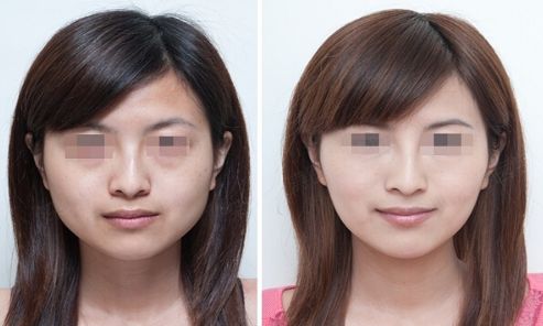 蘇州專業(yè)美容醫(yī)院哪家吸脂效果好？