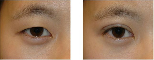 西安激光雀斑治療哪家醫(yī)院好？權威專家?guī)湍惴治鲎罴堰x擇