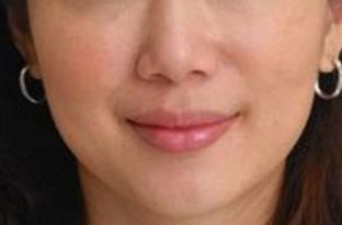 醫(yī)療整形2023年開封十強(qiáng)腰部溶脂針注射醫(yī)院推薦