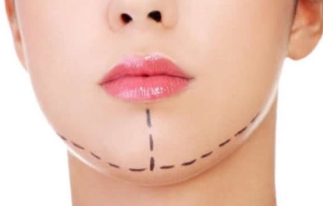 廣州修復(fù)雙眼皮哪家好？選擇最適合您的雙眼皮修復(fù)醫(yī)院