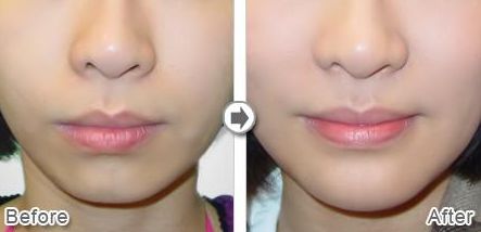 合肥哪家醫(yī)院臀部吸脂好？臀部吸脂手術(shù)哪家醫(yī)院技術(shù)高超，效果明顯？