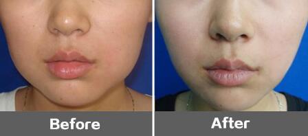 什么是新型美容術(shù)，價(jià)格如何？