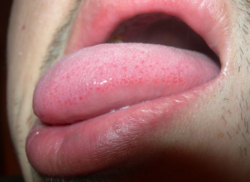 廣東哪家醫(yī)院去眼袋效果好？選對(duì)醫(yī)院很關(guān)鍵！