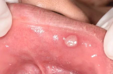 北京填充玻尿酸，選擇哪家醫(yī)院最靠譜？