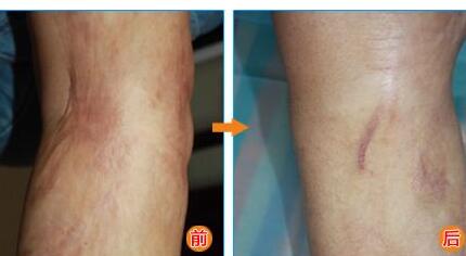 30歲肌膚還能用BOTOX除皺果嗎？