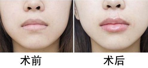 杭州雙眼皮效果好的醫(yī)院有哪些？