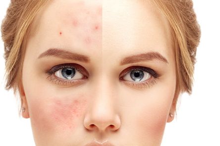 新疆祛痘印醫(yī)院排名及口碑哪家好？