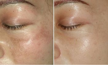 深圳南山牙齒矯正哪家醫(yī)院效果好？