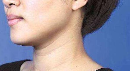 換膚果芯絲翠果酸有效改善肌膚問題嗎？