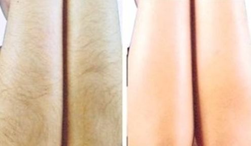 昆明哪家醫(yī)院專業(yè)治療雀斑效果好？