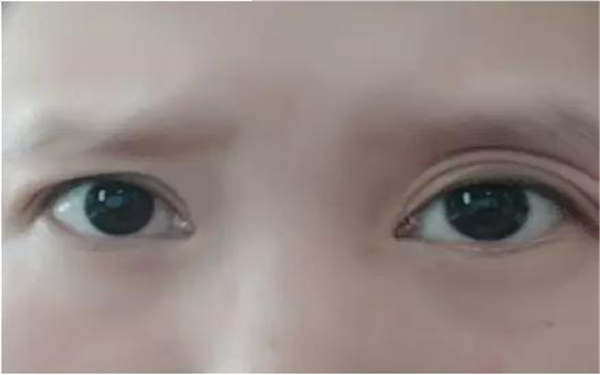 愛拉絲提玻尿酸在術(shù)前術(shù)后會有移位風(fēng)險嗎？疑似有解答！