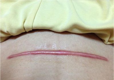 注射玻尿酸去褶皺前需要注意的事項(xiàng)有哪些？