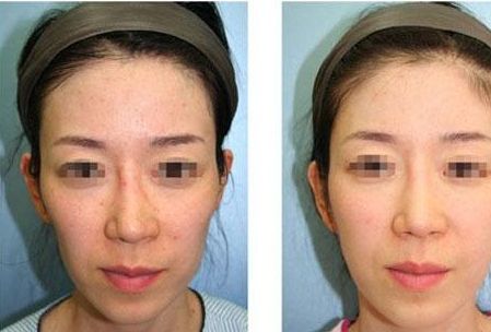 揭秘李宇春的眼睛整容傳聞：真相究竟如何？