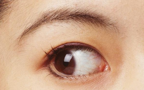 什么牌子的玻尿酸最適合成都隆鼻手術？