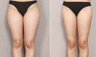 西安做自體豐胸哪家好？揭秘西安自體豐胸神奇醫(yī)院