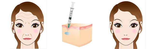 玻尿酸瘦臉，瘦臉神器是什么？