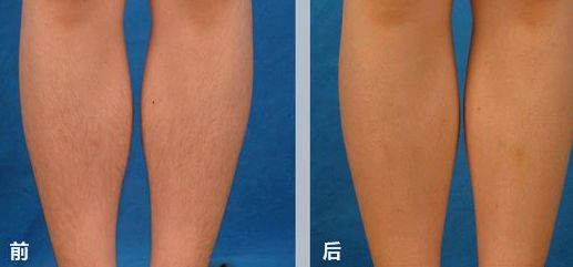 哈爾濱哪家醫(yī)院的隆胸手術(shù)比較受歡迎？