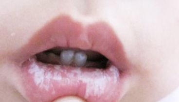 合肥疤痕治療哪家醫(yī)院好？專家推薦，無(wú)痛治療快速療效明顯