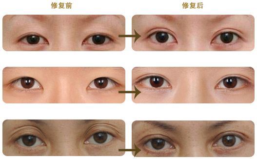 南陽眼袋醫(yī)院綜合評(píng)比揭秘：公立與私立對(duì)比調(diào)查結(jié)果公開