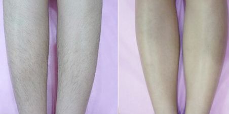 成都眼綜合手術(shù)哪家醫(yī)院好？綜合手術(shù)方案推薦及術(shù)后效果對比